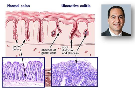 کشف تأثیر طول خواب در ابتلا به کولیت اولسراتیو کشف تأثیر طول خواب در ابتلا به کولیت اولسراتیو