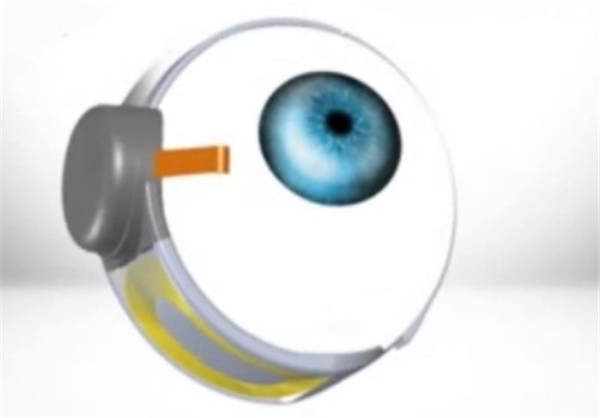 زن نابینا با چشم مصنوعی بینا شد+تصاویر زن نابینا با چشم مصنوعی بینا شد+تصاویر