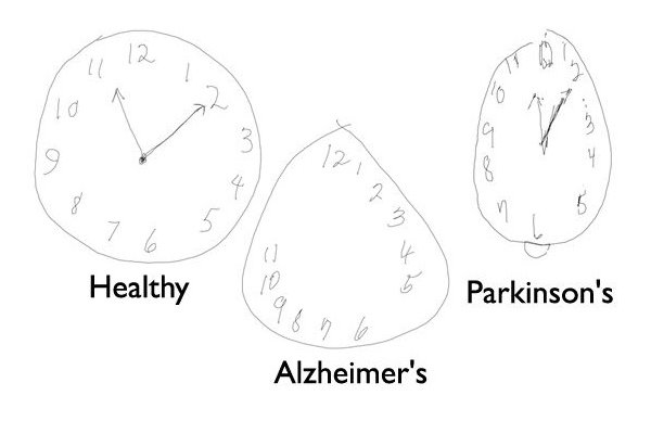تشخیص آلزایمر و زوال عقل با قلم دیجیتالی تشخیص آلزایمر و زوال عقل با قلم دیجیتالی