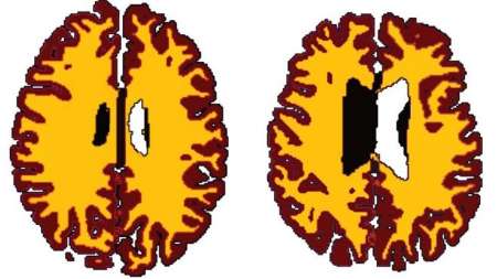 چاقی مغز را 10 سال پیرتر می کند چاقی مغز را 10 سال پیرتر می کند