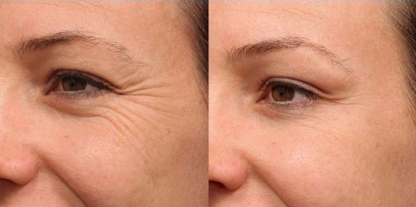 تزریق ژل لب طبیعی در کلینیک پوست و مو رز