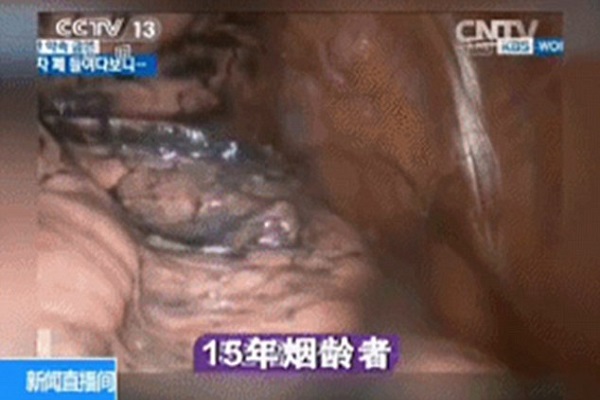 تاثیر سیگار کشیدن بر ریهها به روایت تصویر تاثیر سیگار کشیدن بر ریهها به روایت تصویر