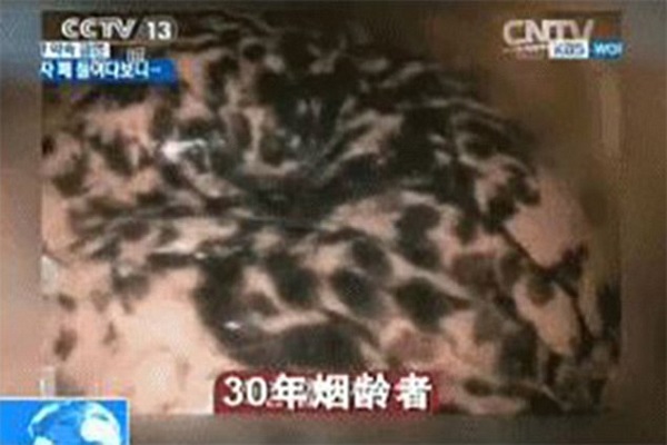 تاثیر سیگار کشیدن بر ریهها به روایت تصویر تاثیر سیگار کشیدن بر ریهها به روایت تصویر