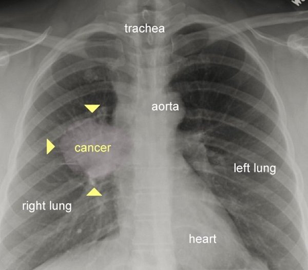 تاثیر سیگار کشیدن بر ریهها به روایت تصویر تاثیر سیگار کشیدن بر ریهها به روایت تصویر