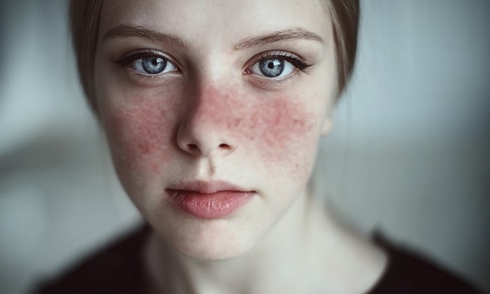 لوپوس و 8 محرک احتمالی آن لوپوس و 8 محرک احتمالی آن