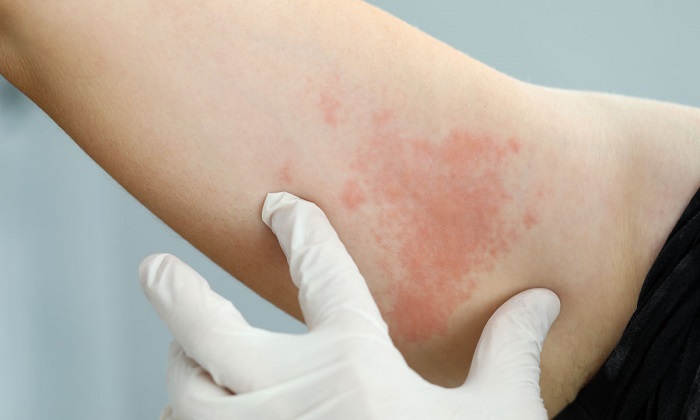 کهیر مزمن و تاثیر آن بر کیفیت زندگی انسان کهیر مزمن و تاثیر آن بر کیفیت زندگی انسان