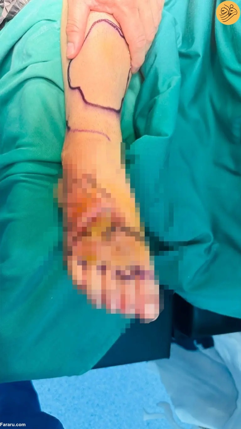 دلفین بخشی از پای زن شناگر را خورد (+عکس)