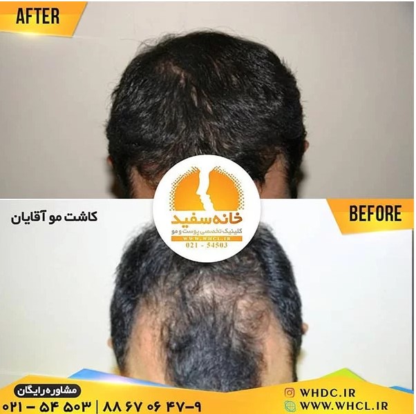 کاشت مو به روش میکروگرافت کاشت مو به روش میکروگرافت