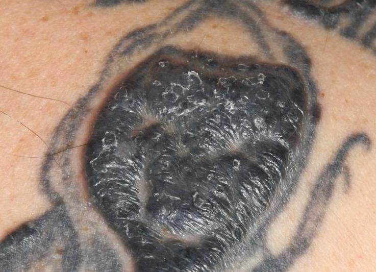 آیا تتو سرطان زاست؟ علم روز دنیا در این مورد چه می گوید