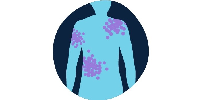 سرطان خون و همه چیز درباره نشانه های آن