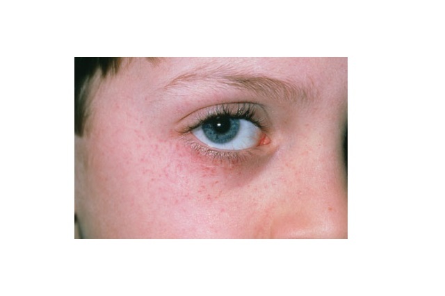 پتشی: علل، علائم و درمان/ چه زمانی به پزشک مراجعه کنیم(+عکس) پتشی: علل، علائم و درمان/ چه زمانی به پزشک مراجعه کنیم(+عکس)