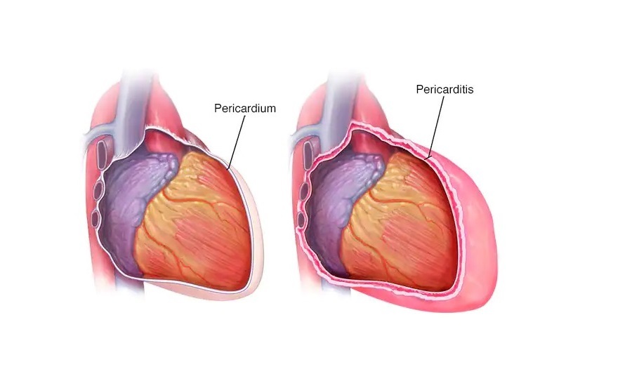 نشانگان درسلر چیست و چه اهمیتی دارد؟