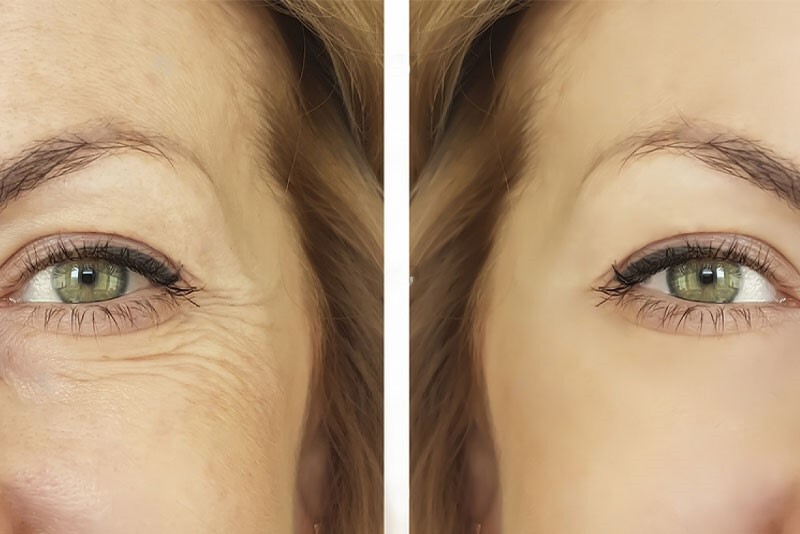 همه چیز در مورد چین و چروک دور چشم همه چیز در مورد چین و چروک دور چشم