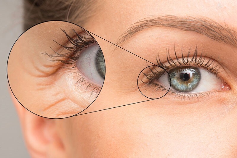 همه چیز در مورد چین و چروک دور چشم همه چیز در مورد چین و چروک دور چشم