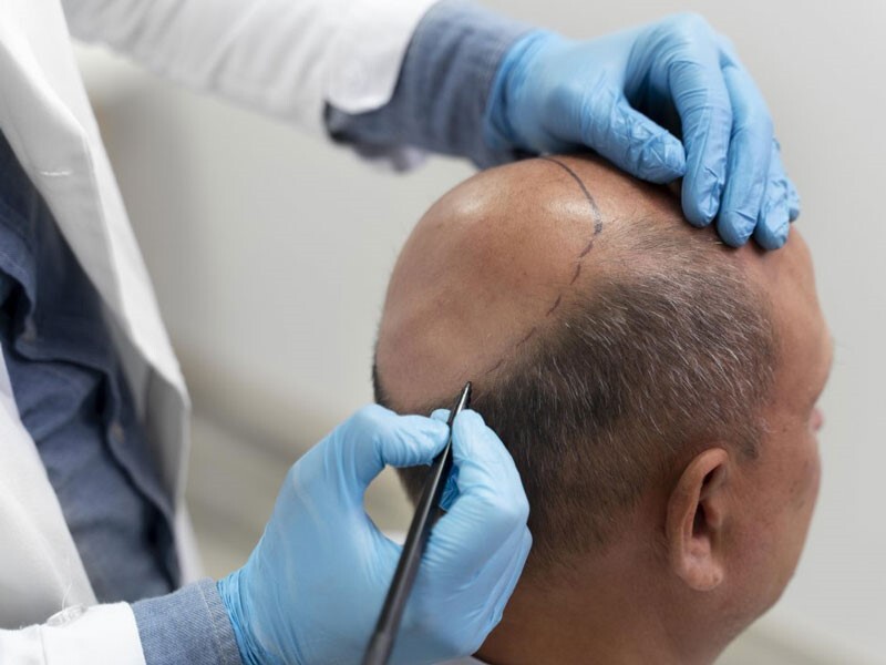 جدیدترین روش های کاشت مو و ابرو در ایران و جهان جدیدترین روش های کاشت مو و ابرو در ایران و جهان